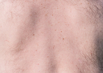 Close up detail of the bare skin on a man back with scattered moles and freckles