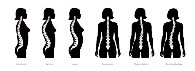 Spinal deformity flat vector illustration
