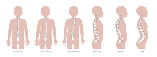 Boy spinal deformity flat vector illustration