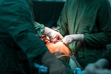 Urgent surgery. total hip arthroplasty with cement fixation of components. Professional smart intelligent surgeons standing near the patient and performing an operation while saving his life