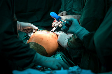 hip arthroplasty surgery. Group of surgeons in operating room with surgery equipment. medical background