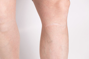 Scar on a girl's leg close-up. Varicose veins from the injury on the leg on a white isolated background.