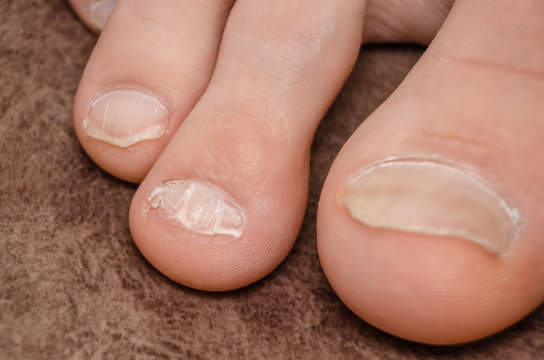 Close-up of a broken toenail of a Caucasian man on a gray carpet, a podology problem.