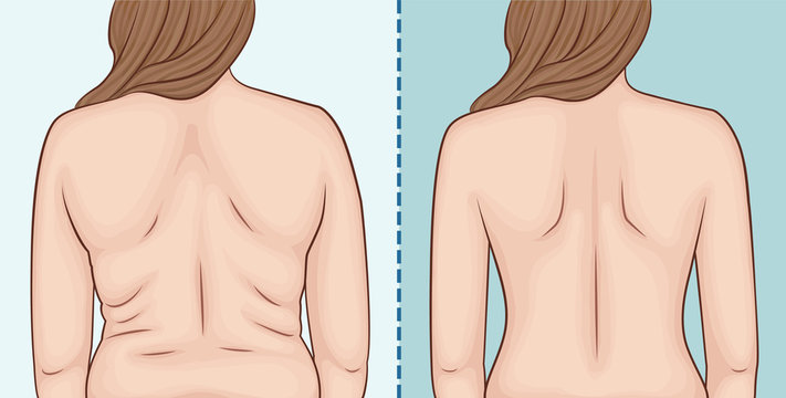 Women's back before and after weight loss.