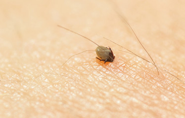 Small Ixodes ricinus bug on human skin sucking blood