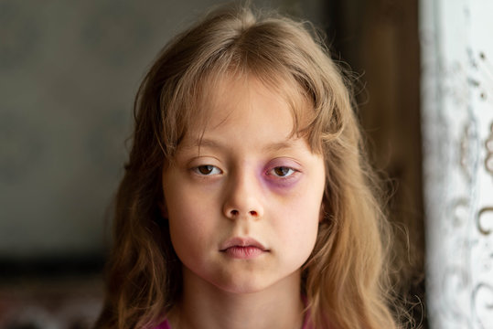 Portrait of a sad and scared little girl with beating. Child domestic abuse.