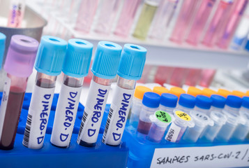 Blood samples with high levels of dimero-D from Sars-Cov-2 infected patients in a laboratory, conceptual image