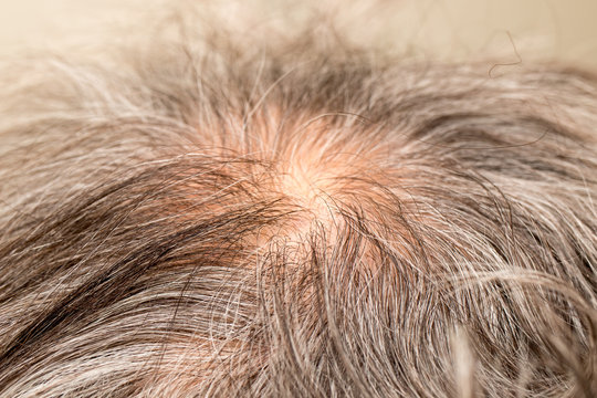 Older Man With Thinning Hair On The Back Of His Head Around The Crown