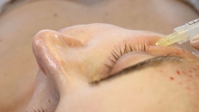 Needle mesotherapy in beauty spa salon or clinic. Cosmetics being injected to young woman, close-up. Beautician making multiple facial injections into female skin. Mesotherapy and face procedure. 4 k