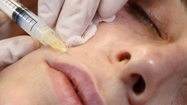Needle mesotherapy in beauty spa salon or clinic. Cosmetics being injected to young woman, close-up. Beautician making multiple facial injections into female skin. Mesotherapy and face procedure. 4 k