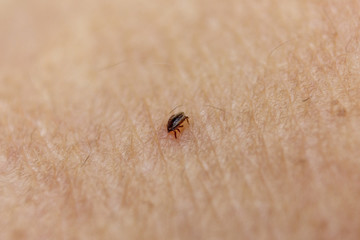 Tick bitten in human skin 6