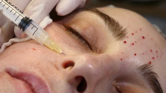Anti-aging skin procedure: professional cosmetologist makes multiple facial injections leaving traces and papules. mesotherapy treatment in process. beautician holds syringe for injection. Close-up. 4
