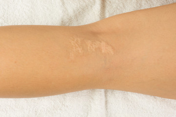 Scar on a woman´s leg