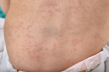 roseola rash a viral rash on the skin of a child