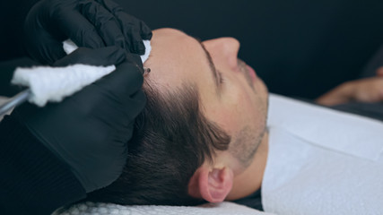 High quality close-up of a man laying on a couch during the esthetician hair treatment. Male tricopigmentation service. Scalp micropigmentation treatment. Trichopigmentation procedure.