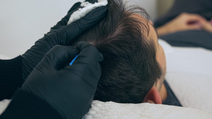 High quality close-up of a man laying on a couch during the esthetician hair treatment. Male tricopigmentation service. Scalp micropigmentation treatment. Trichopigmentation procedure.