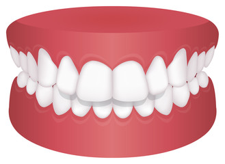 Teeth trouble ( bite type ) vector illustration //Overbite (Back teeth)