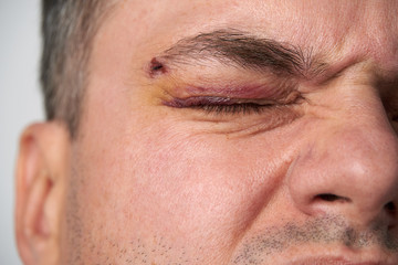 Obraz premium close view of a black eye, man's face with a hematoma