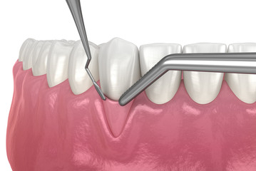Gum Recession: Soft tissue graft surgery. 3D illustration of Dental  treatment - obrazy, fototapety, plakaty