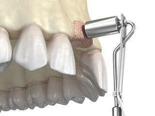 Bone grafting- augmentation using ring method, tooth implantation. Medically accurate 3D illustration