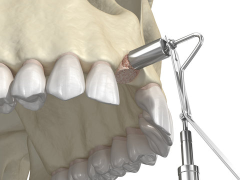 Bone grafting- augmentation using ring method, tooth implantation. Medically accurate 3D illustration