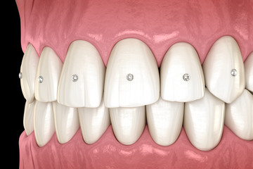 Teeth decoration with jewelry, 3D illustration concept.
