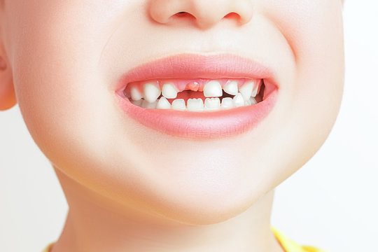 Closeup of a boy's mouth without one tooth. Milk teeth, oral protection, dental care in children concept