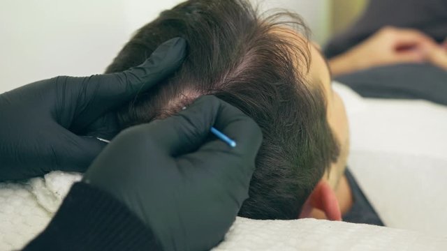 High quality close-up 4k slow motion video of a man laying on a couch during the esthetician hair treatment. Male tricopigmentation service. Scalp micropigmentation treatment. 