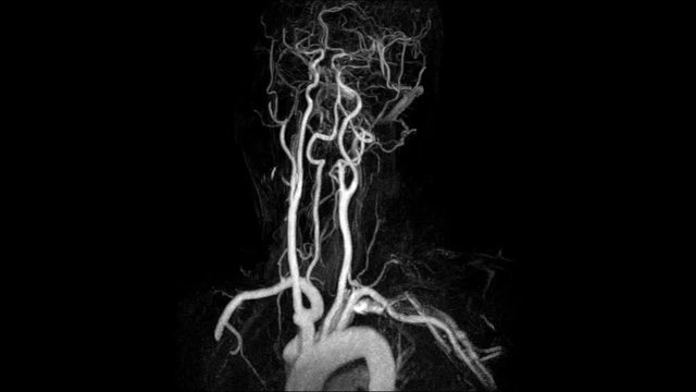 Magnetic Resonance Angiography(MRA)of the brain or cta brain 3D Rendering image white color rotating on the screen from mra scanner. medical footage concept..