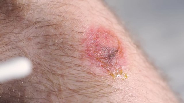 A wound on the knee after falling from the bike. Sports injury