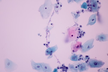View in microscopic of Candidiasis, fungus infection (Yeast and Pseudohyphae form) in pap smear...