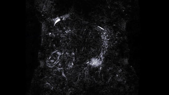 Magnetic resonance cholangiopancreatography or MRCP 3D Coronal MIP view showing visualize the biliary and pancreatic ducts .