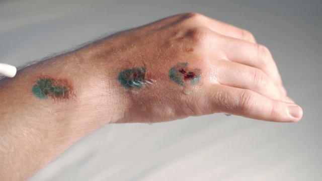 cleaning infected wound on arm