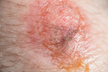 Fototapeta premium wound on the skin. macro