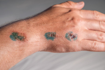 Man show red lesion or wound on his arm after accident