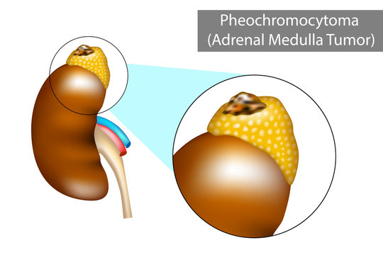 Pheochromocytoma (PH or PCC). Adrenal Gland Tumor