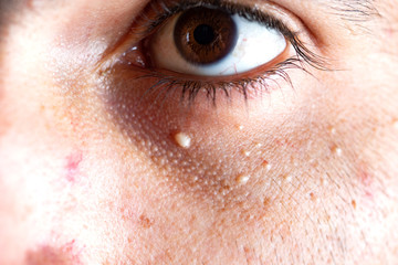 skin problem under the eyes
