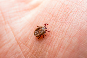 Lyme Disease Infected Tick Insect Crawling on Skin. Encephalitis Virus or Lyme Borreliosis Disease Infectious Dermacentor Tick Arachnid Parasite Macro.