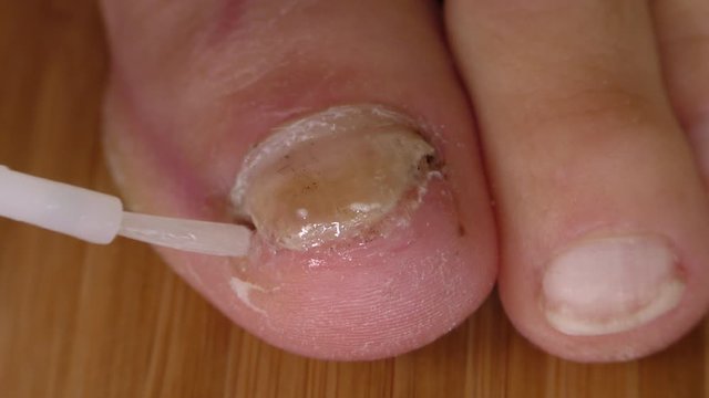 Close up of treatment of fungal infected toe nail with tincture.