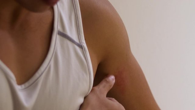 muscular man in white tank top scratch his left arm rash, white background, skin allergy symptom, body health care product, scratching skin allergic,  day time natural light, itchy skin surface