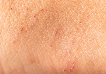 Fototapeta premium A wound on the skin of a person as a background.