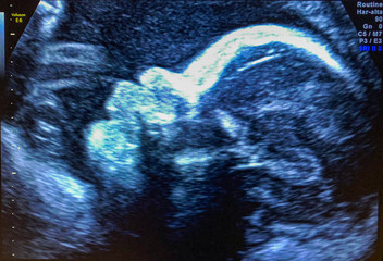 Baby's face ultrasound, 30 weeks pregnancy