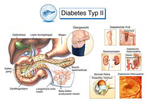 Bauchspeicheldruese. Diabetes Typ II