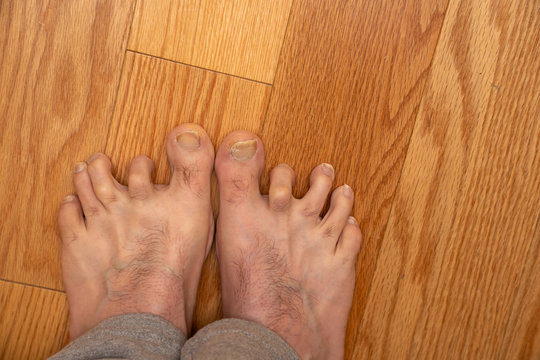 Mens Hammer Toes With Dislocated Joints Before Surgery 