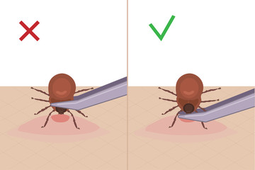 A tick bites a person. How to remove a tick from the skin. A parasite carrying a disease. Vector illustration