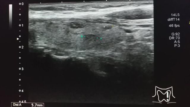 Computer screen with Thyroid and Parathyroid Ultrasound.