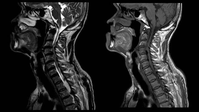 MRI OF CERVICAL SPINE IMPRESSION: Moderate to severe posterior central disc protrusion of C3/4 to C5/6  intervertebral discs with 2.0 cm in length small posterior subligamentous fluid.Medical footage.