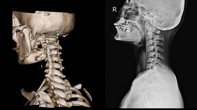 CT Scan cervical spine 3 D render and X-ray C-spine finding Reverse cervical lordosis Thoracic scoliosis with cervical spondylosis.Image contains excessive noise, film grain, compression artifacts.