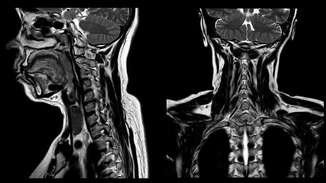MRI C-Spine There is hypersignal intensity lesion in the spinal cord at C4 to C6 levels,too soft and blurry selective focus when views full solution.Medical footage.