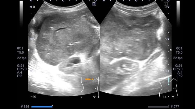 Blurry Ultrasound Whole : Abdomen Showing laarge gastric tumor of body and antrum with luminal narrowing of gastic antrum.Liver,GB,CBD,pancreas,spleen and both kidneys are normal.